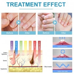 South Moon Nail Fungal Cleaning Laser Relief Device, Gray Nail Bad Nail Thickening Soft Nail Bright Nail Care Instrument