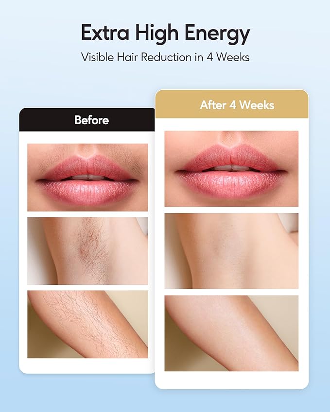 INNZA IPL Hair Removal with Ice Cooling Care Function for Women,Long-Lasting Results,999,999 Flashes Painless IPL Hair Remover, Hair Removal Device for Armpits Legs Arms Bikini Line, Corded